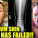 Conor McGregor’s injury for which is pulled out of UFC 303 REVEALED,Chandler should continue to wait